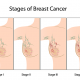 breast cancer
