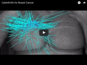 CyberKnife Radiation Therapy for Breast Cancer