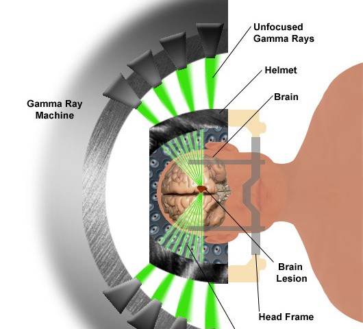 Stereotactic Radiosurgery