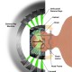 Stereotactic Radiosurgery