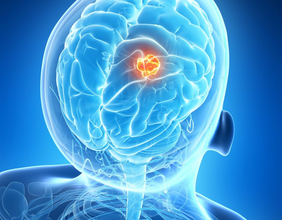 3D image of brain tumor